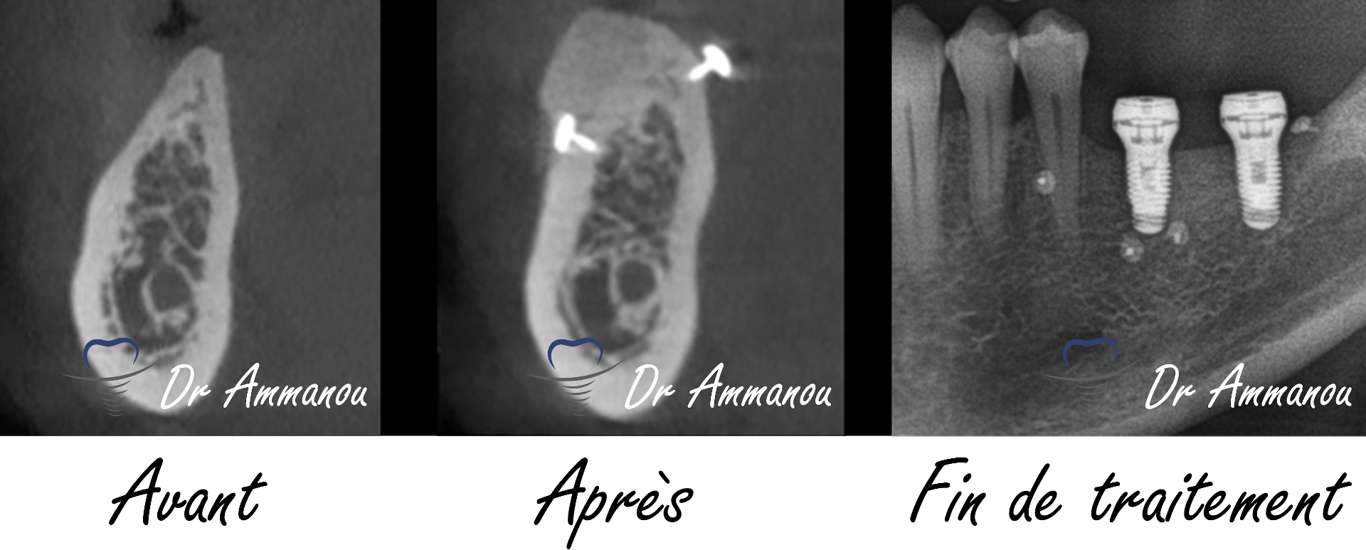 Greffes osseuses Le Perreux sur Marne (94170) d